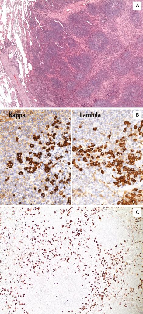 FIG. 22.7, Nodular lymphoid hyperplasia. (A) Nodular lymphoid hyperplasia consists of a well-demarcated mass containing aggregates of reactive germinal centers. (B) A polyclonal pattern (similar proportions of lambda and kappa light chains) is seen with immunohistochemical staining for lambda and kappa light chains. (C) A subset of cases shows a marked increase in IgG4-positive plasma cells (IgG4 immunohistochemical stain).