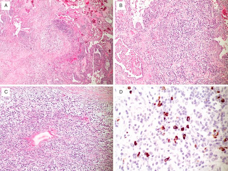 FIG. 22.8, Pulmonary involvement by IgG4-related disease. (A) Low-power view shows a large fibroinflammatory mass. (B) The mass consists of irregular fibrosis and a lymphoplasmacytic infiltrate involving bronchovascular bundles. (C) Lymphoplasmacytic inflammation permeates the wall and intima of this small vein. (D) An increased number of IgG4-positive plasma cells is present (IgG4 immunohistochemical stain).