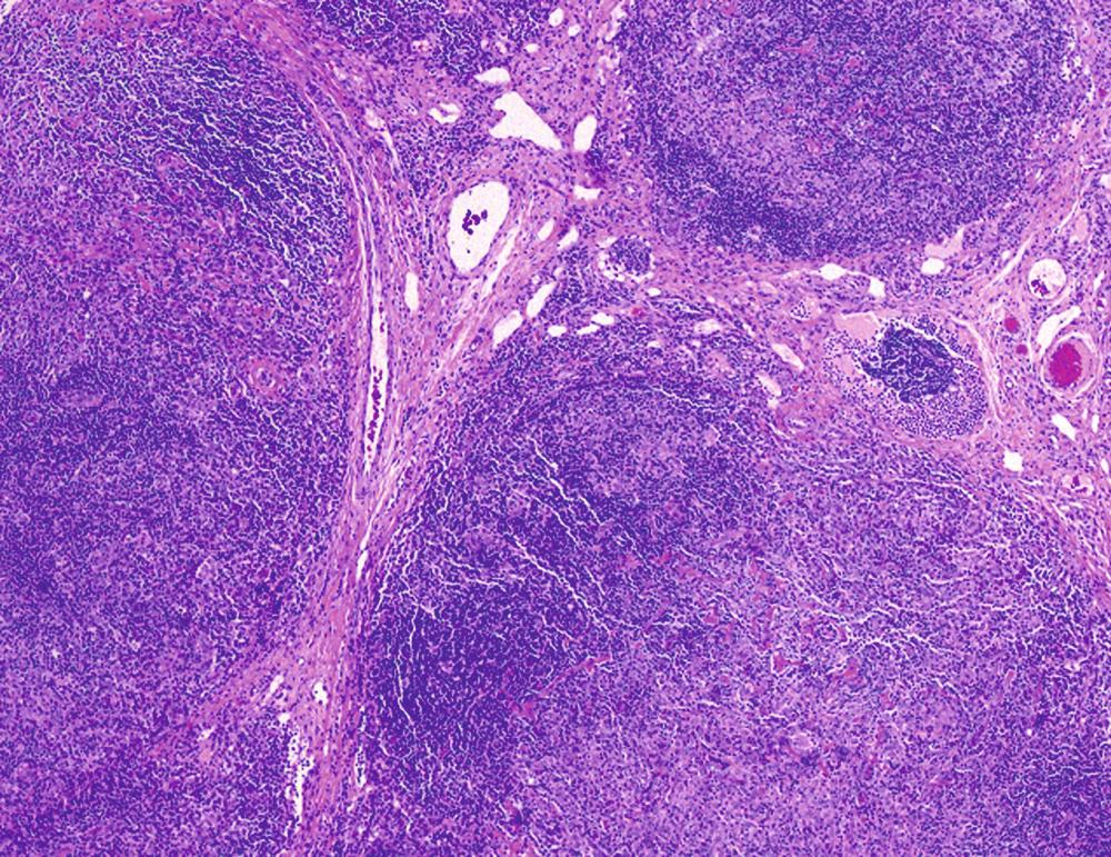 Fig. 68.3, The histologic image depicts the nodular sclerosis form of HL (H&E stain, 50× magnification) with tumor nodules surrounded by broad sclerotic bands that arise from a thickened fibrotic capsule.