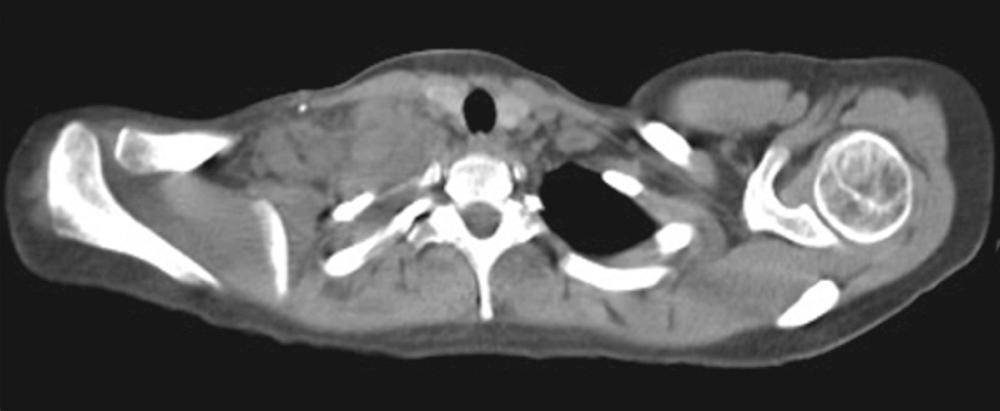 Fig. 116.1, Neck computed tomography scan of a 23-year-old woman with classic Hodgkin lymphoma showing a conglomeration of bulky, right supraclavicular lymph nodes adjacent to the right thyroid lobe.