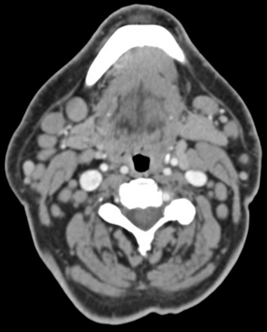 Fig. 116.2, Neck computed tomography scan of an 81-year-old man with small lymphocytic lymphoma showing bilateral diffuse cervical lymphadenopathy.