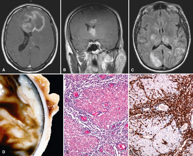 Fig. 17.1, Patterns of involvement by lymphoma in the nervous system. Primary central nervous system lymphoma (PCNSL) can be solitary (A) or multifocal (B) with typically contrast-enhancing deep periventricular masses (A, B, postcontrast magnetic resonance imaging [MRI]). A rare form of diffuse PCNSL is known as lymphomatosis cerebri and radiologically resembles encephalitis or gliomatosis cerebri (C, fluid-attenuated inversion recovery [FLAIR] MRI). Retinal extension is seen in a subset of PCNSL (D, gross image of eye in cross section), whereas the rare involvement of the peripheral nervous system is referred to as neurolymphomatosis (E, H & E; F, CD20). PCNSL often leads to diffuse effacement of brain structures, as seen here in the striatum (G, gross image of coronal brain section). PCNSL in immunodeficient patients often shows large necrotic areas (H, gross image of coronal brain section).