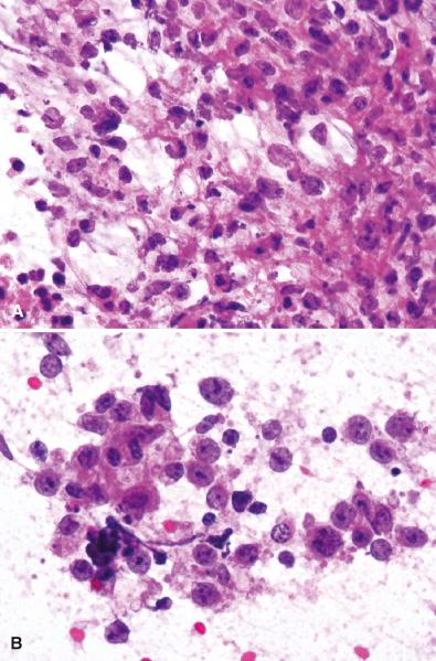 Fig. 17.3, Intraoperative diagnosis of primary central nervous system lymphoma. Frozen section diagnosis is often difficult due to increased pleomorphism and artifacts simulating background fibrillarity (A). However, intraoperative smears show superior cytologic preservation with classic features such as lack of cohesion, scant cytoplasm, and nucleolar prominence (B).