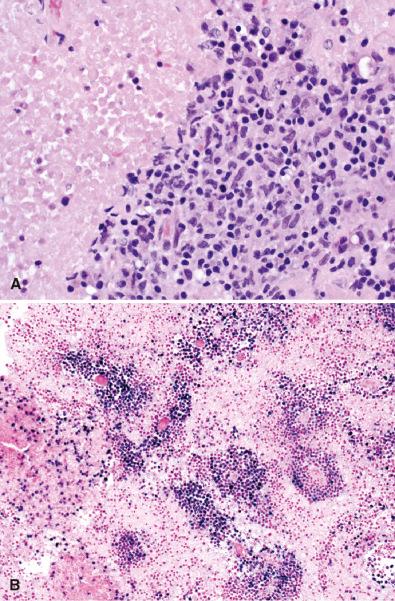 Fig. 17.4, Immunodeficiency-associated primary central nervous system lymphoma (PCNSL). Necrosis is often a prominent feature in PCNSL from immunocompromised patients (A, H & E). Additionally, they are virtually always EBV positive (B, Epstein-Barr virus–encoded RNA in situ hybridization).