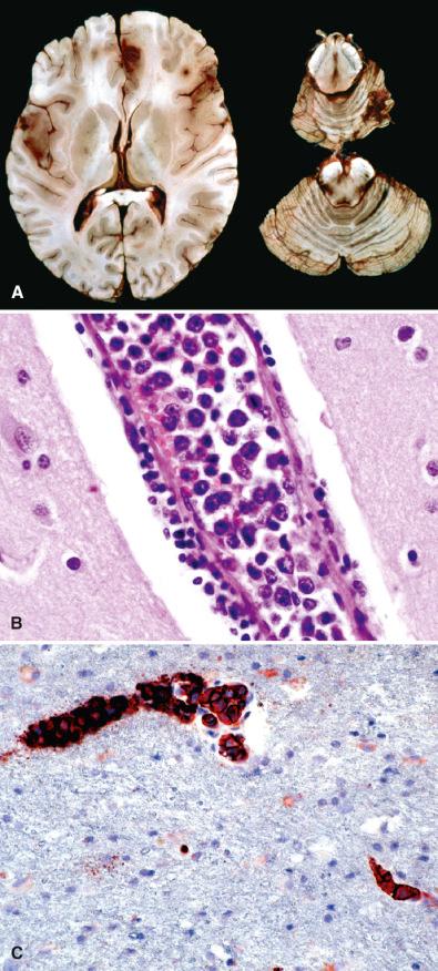 Fig. 17.6, Intravascular lymphoma. Occlusion of central nervous system vessels by tumor cells leads to multiple hemorrhagic infarcts (A, gross). Tumor cells are cytologically consistent with diffuse large B cell lymphoma, but are largely restricted to intravascular spaces, mostly in the central nervous system (B, H & E; C, CD20).