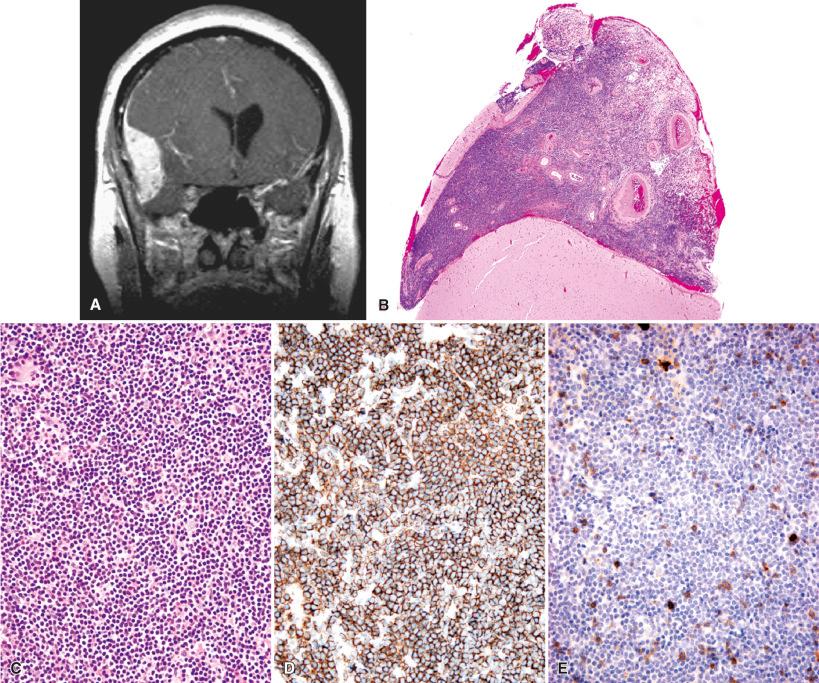 Fig. 17.7, Marginal zone (mucosa-associated lymphoid tissue) lymphoma. This low-grade primary lymphoma typically involves the dura and radiologically mimics meningioma (A, contrast-enhanced T1-weighted MRI). Leptomeningeal involvement is also common (B, H & E). Cytologically, the tumor cells are small to midsize lymphocytes with pale cytoplasm (C, H & E). Tumor cells stain with B cell markers and are often intermixed with reactive T cells (D, CD20; E, CD3).