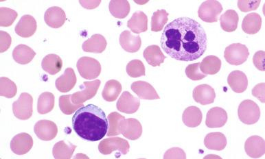 Figure 15-1, Peripheral blood findings in lymphoplasmacytic lymphoma.