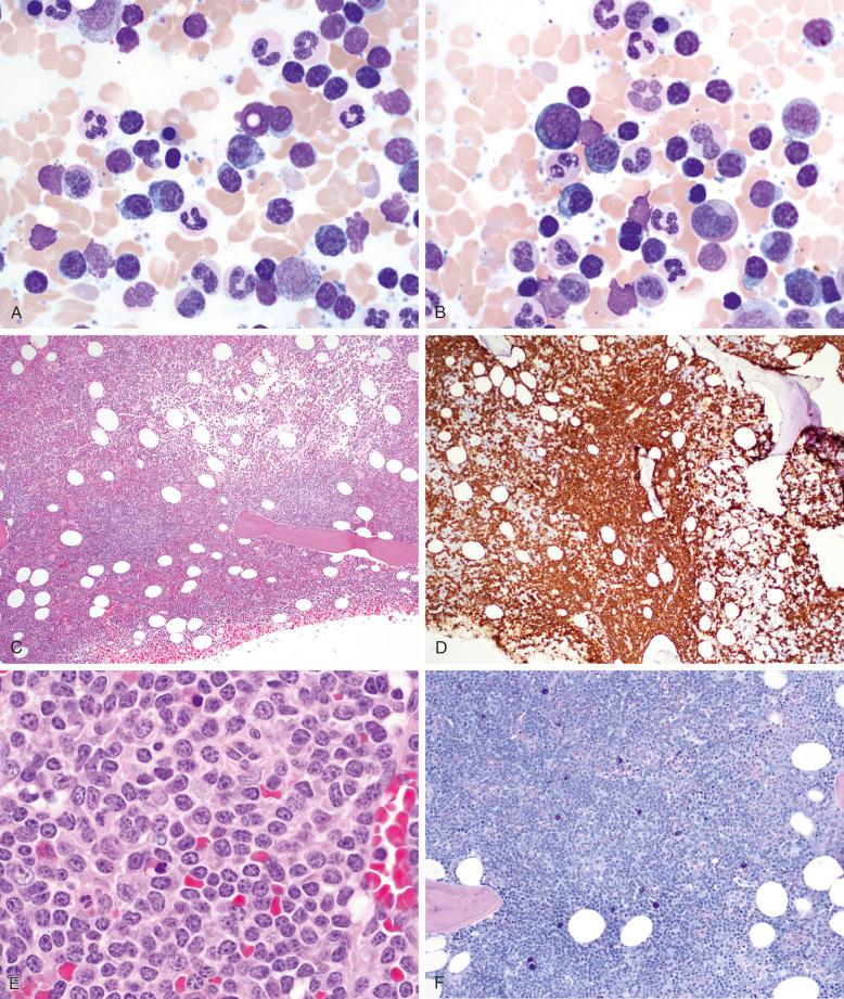 Figure 15-2, Bone marrow involvement by lymphoplasmacytic lymphoma.