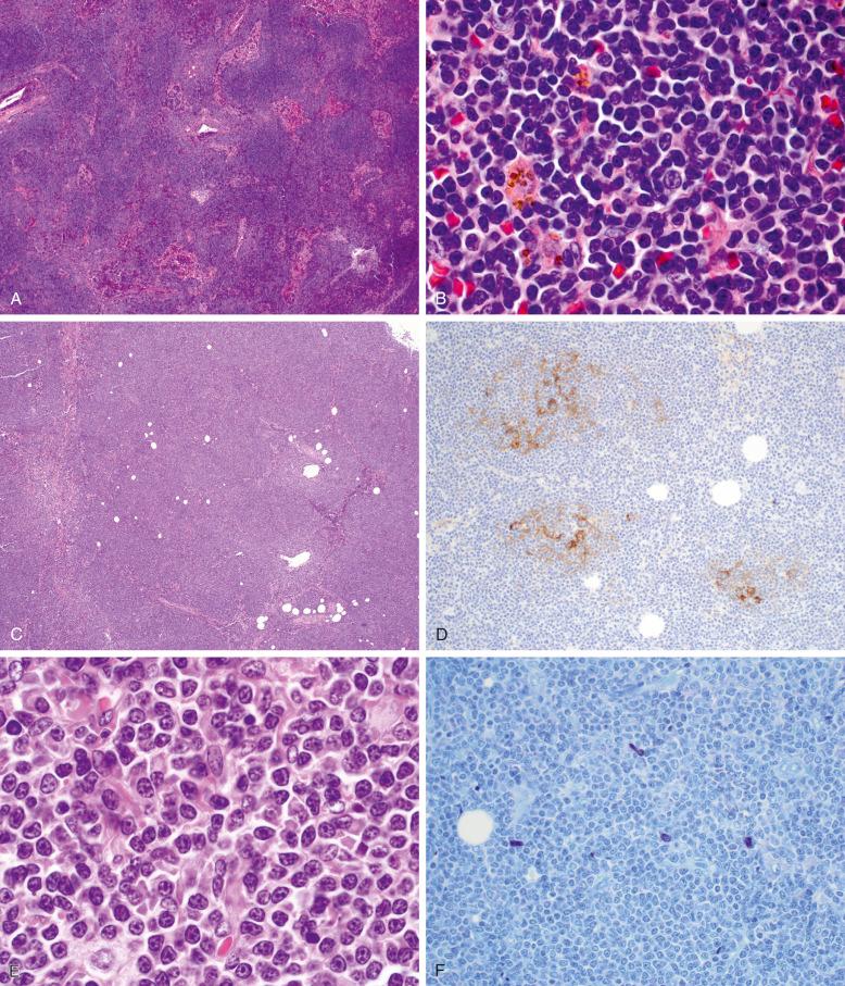 Figure 15-3, Spectrum of nodal involvement by lymphoplasmacytic lymphoma.