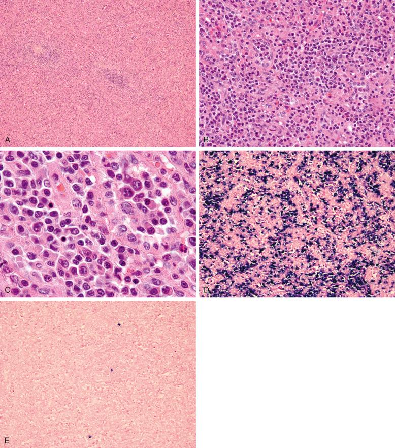 Figure 15-4, Splenic involvement by lymphoplasmacytic lymphoma.