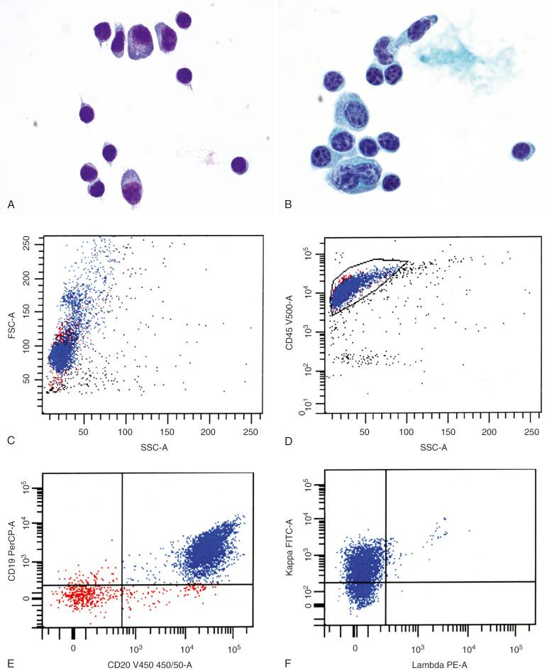 Figure 15-5, Cerebrospinal fluid (CSF) involvement by lymphoplasmacytic lymphoma (Bing-Neel syndrome).