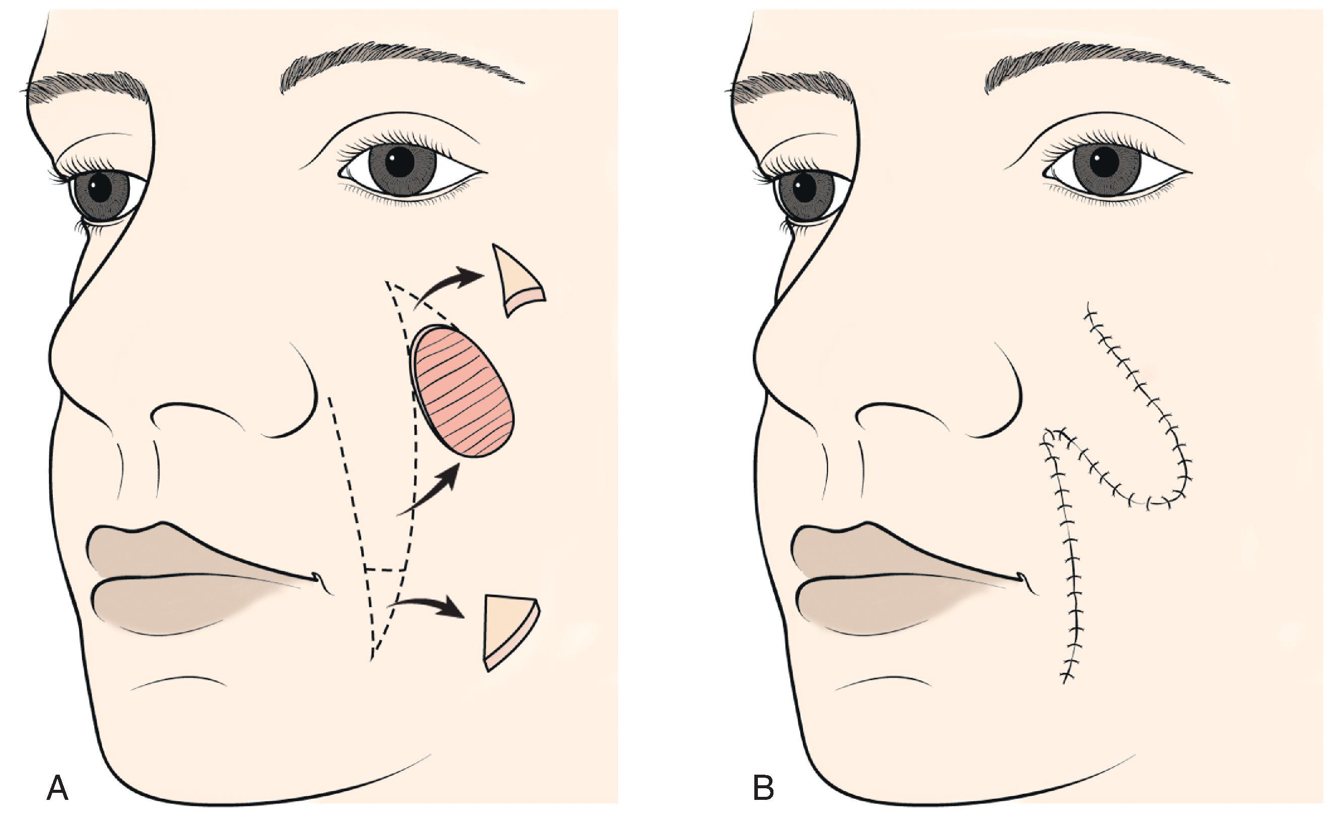 FIG. 12.1, A , Skin defects of the medial cheek can be repaired with melolabial transposition flaps. Broken line outlines incision for flap. B , Standing cutaneous deformities removed from base of flap and cheek donor site upon flap transfer and closure of donor site.