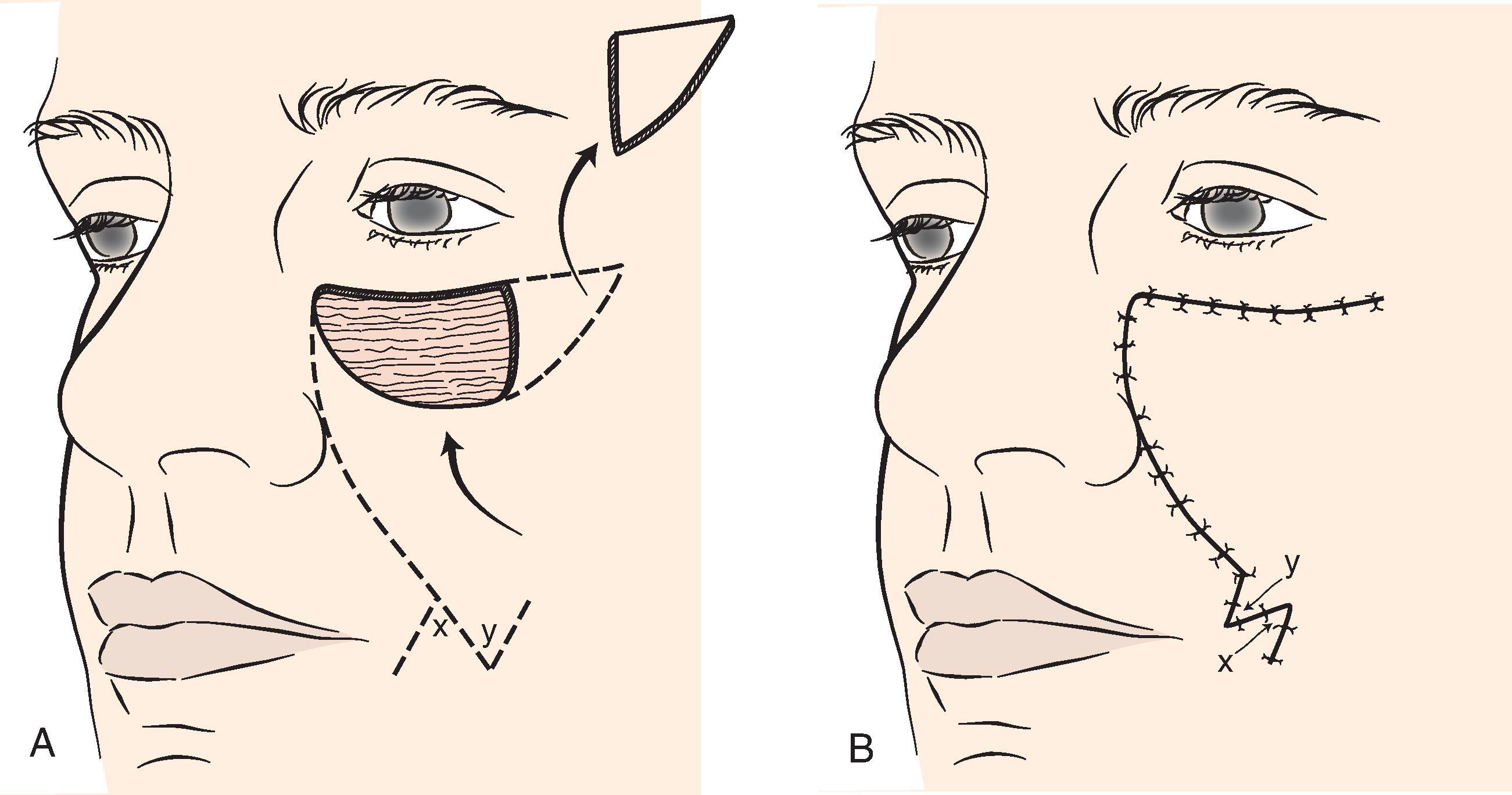 FIG. 12.2, A , B , When used to repair skin defects of superomedial cheek, melolabial advancement flaps are usually designed with single long incision placed in or parallel to melolabial crease. Skin is undermined lateral to crease.