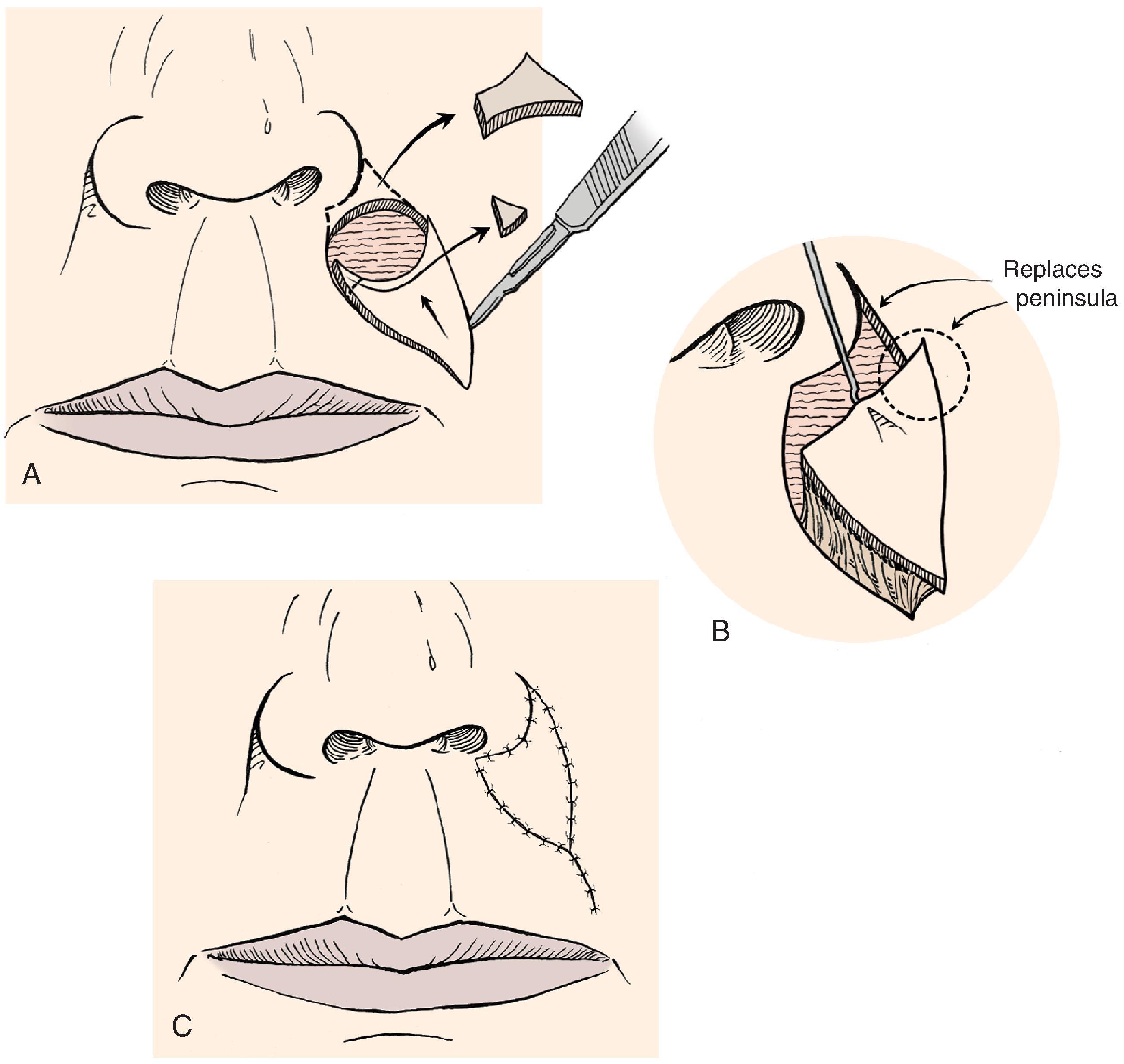 FIG. 12.3, Melolabial subcutaneous tissue pedicle island advancement flaps are particularly suited for repair of skin defects adjacent to alar base. A , Defect enlarged to remove peninsula of skin between ala and melolabial fold. Island flap designed to replace skin peninsula. B , Flap is based on subcutaneous fat of melolabial fold. C, Superior and lateral portions of wound closure suture lines are in aesthetic boundaries.