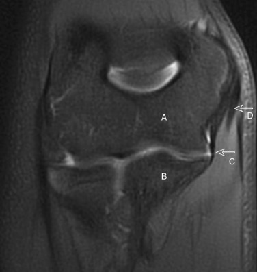 Figure 53-1, Normal elbow anatomy on MRI. Coronal fat-suppressed T2-weighted image of elbow shows trochlea ( A ) and ulna ( B ) comprising ulnotrochlear joint. Ulnar collateral ligament ( C ) attaches on inferior aspect of medial epicondyle of humerus and extends to sublime tubercle of ulna. Overlying ulnar collateral ligament is common flexor tendon ( D ).