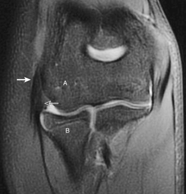 Figure 53-2, Normal elbow anatomy on MRI. Coronal fat-suppressed T2-weighted image of elbow shows capitellum ( A ) and radial head ( B ) at radiocapitellar joint articulation. Common extensor tendon ( closed arrow ) originates at lateral epicondyle of humerus. Deep to common extensor tendon is radial collateral ligament ( open arrow ).