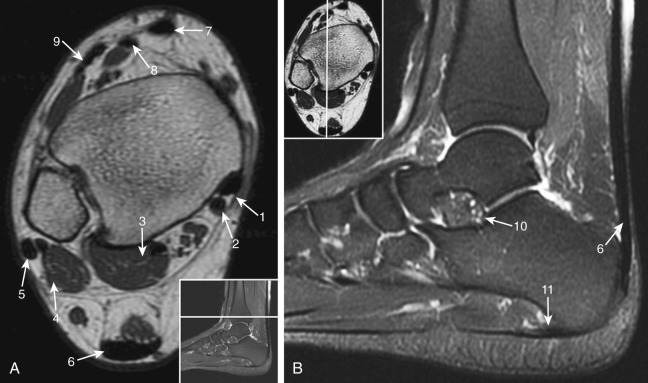 Figure 57-1, Normal anatomy of ankle on MRI. A, Axial T1-weighted image. B, Sagittal fat-suppressed T2-weighted image. 1 = posterior tibialis tendon, 2 = flexor digitorum longus tendon, 3 = flexor hallucis longus tendon and muscle, 4 = peroneus brevis tendon and muscle, 5 = peroneus longus tendon, 6 = Achilles tendon, 7 = tibialis anterior tendon, 8 = extensor hallucis longus tendon, 9 = extensor digitorum longus tendon, 10 = sinus tarsi, 11 = plantar fascia.