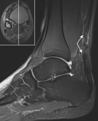 Figure 57-2, Achilles tendon rupture on MRI. Sagittal fat-suppressed T2-weighted image shows complete rupture of Achilles tendon in hypovascular watershed region. Note large amount of surrounding soft tissue edema and large gap between torn tendon ends ( arrows ).