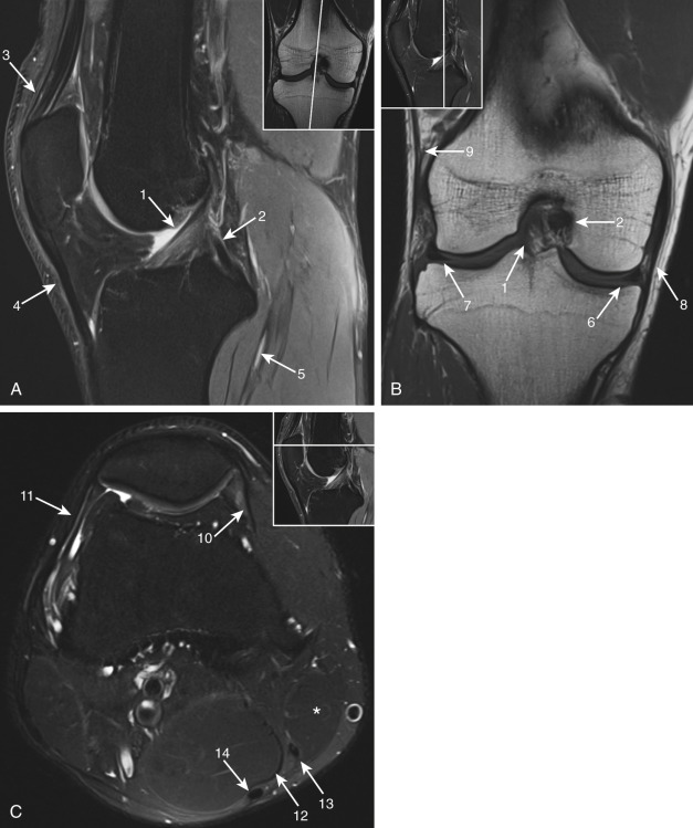 Figure 56-1, Normal knee anatomy on MRI. A, Midsagittal fat-suppressed PD-weighted image. B, Coronal T1-weighted image. C, Axial fat-suppressed T2-weighted image. 1 = anterior cruciate ligament (ACL), 2 = posterior cruciate ligament (PCL), 3 = quadriceps tendon, 4 = patellar tendon, 5 = popliteus muscle, 6 = medial meniscus, 7 = lateral meniscus, 8 = medial collateral ligament (MCL), 9 = iliotibial band, 10 = medial patellar retinaculum, 11 = lateral patellar retinaculum, 12 = semimembranosus muscle and tendon, 13 = gracilis tendon, 14 = semitendinosus tendon, * = sartorius muscle and tendon.