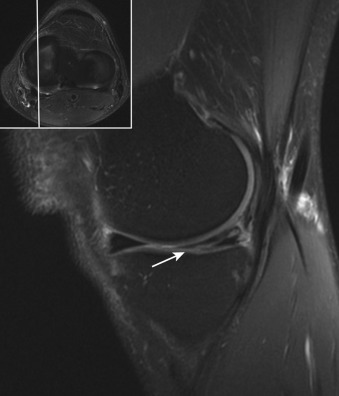 Figure 56-2, Meniscal tear on MRI. Sagittal fat-suppressed PD-weighted image shows obliquely oriented increased signal intensity in posterior horn of medial meniscus that extends to inferior articular surface ( arrow ) due to oblique/horizontal tear, which is likely degenerative in nature.