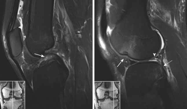 Figure 56-3, ACL rupture, radial lateral meniscal tear, and “kissing contusions” on MRI. A, Midsagittal fat-suppressed PD-weighted image shows complete rupture of ACL with wavy torn ligament fibers in intercondylar notch ( arrow ). Note associated moderate joint effusion in suprapatellar bursa (*). B, Sagittal fat-suppressed PD-weighted image through lateral weight-bearing joint compartment shows feathery high signal intensity bone marrow edema in posterior lateral tibial plateau ( dashed arrow ) and in anterior lateral femoral condyle ( arrow ) due to “kissing contusions” from pivot shift mechanism of injury. Note associated depressed lateral femoral sulcus, which is another indirect sign of ACL rupture. Finally, note absence of normal lateral meniscus ( arrowhead ) in posterior horn representing “ghost meniscus” sign, which indicates radial tear of meniscus along imaging plane.