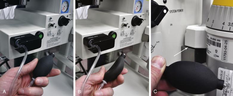 Fig. 25.9, The universal negative-pressure low–pressure system leak test. (A) With the machine off and the flow control valves fully closed, a specially configured suction bulb is connected to the common (fresh) gas outlet. (B) The bulb is pumped until it is fully collapsed; it is then observed to verify that it stays collapsed for more than 10 seconds, indicating that the low-pressure side of the machine is gas tight. Then, each vaporizer is opened in turn, and the maneuver is repeated to establish that no leak is associated with that vaporizer. (C) The vaporizer was intentionally tilted on its mount in order to cause a low–pressure system leak resulting in immediate reexpansion of the suction bulb.