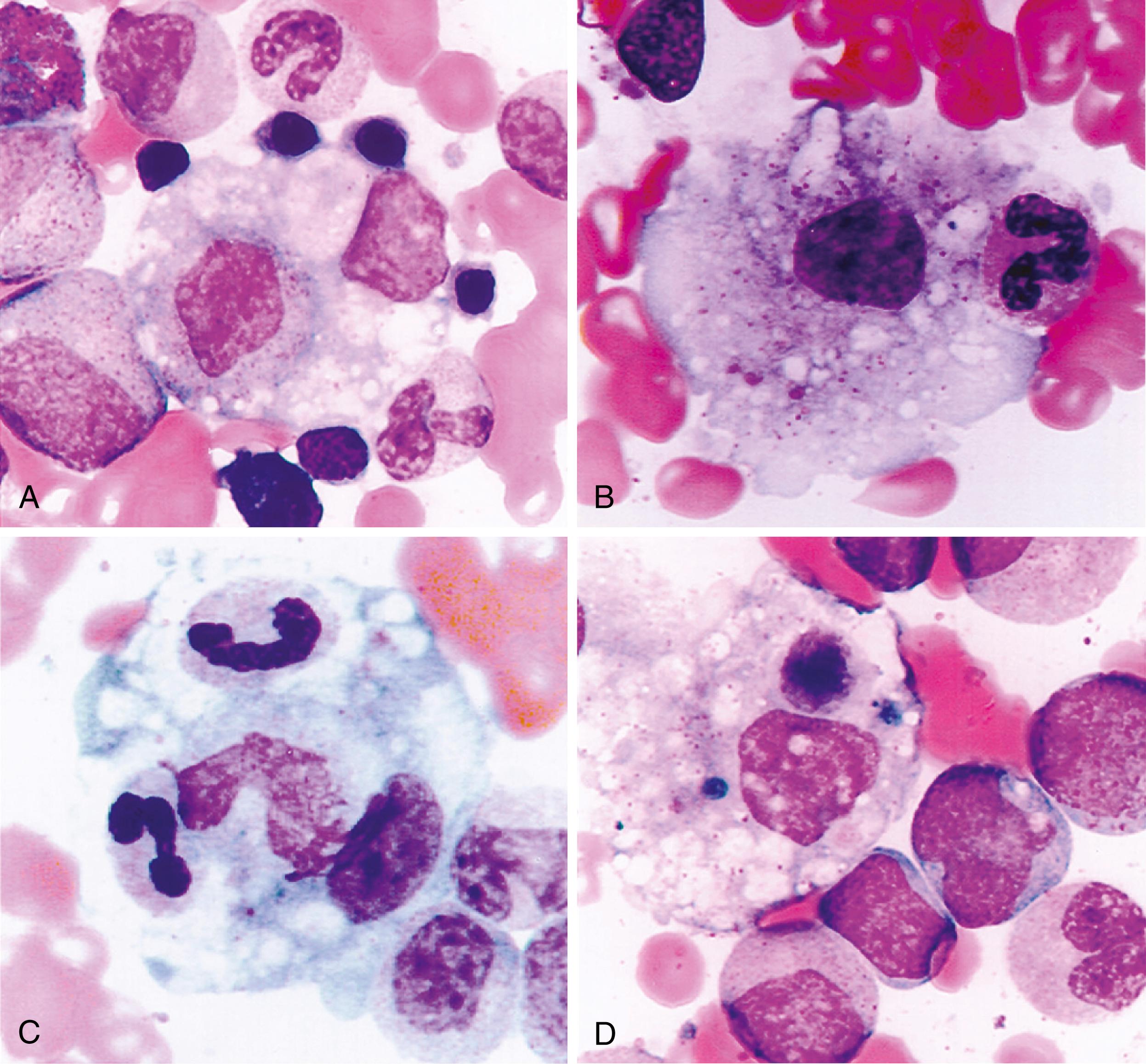 Fig. 42.1, Activated macrophages phagocytosing hematopoietic elements in the bone marrow of a systemic juvenile idiopathic arthritis (JIA) patient with macrophage activation syndrome (MAS). Bone marrow aspirate specimen revealing activated macrophages (H&E stain, original magnification × 1000). A, Myelocyte within activated macrophage. There are also multiple adherent red blood cell and myeloid precursors. B, Activated macrophage engulfing a neutrophilic band form. C, Neutrophilic band forms and metamyelocyte within an activated macrophage. Nuclei of band forms appear condensed, a result of destruction. D, Activated macrophage with hemosiderin deposits and a degenerating phagocytosed nucleated cell.