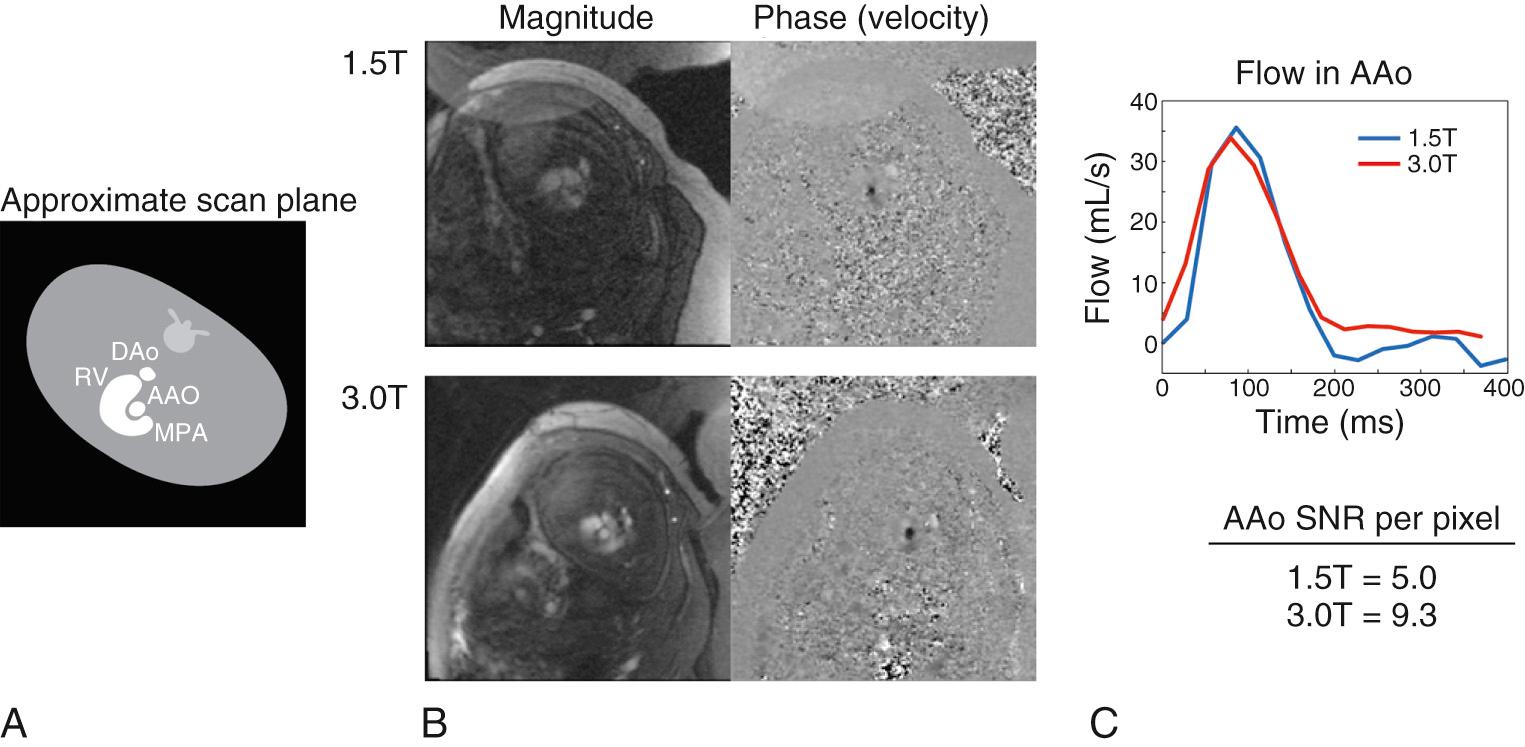 Fig. 7.2, Human fetal cine phase contrast magnetic resonance imaging with metric optimized gating. (A) Imaging plane (short axis of ascending aorta). (B) Midsystolic phase from the cine, with anatomic images on the left and velocity encoded information on the right. (C) Flow curves generated from the phase data. The comparison between 1.5 and 3.0 T reveals improved signal-to-noise ratio (SNR), although the flow quantification is similar. AAo , Ascending aorta; DAo, descending aorta; MPA , main pulmonary artery; RV , right ventricle.