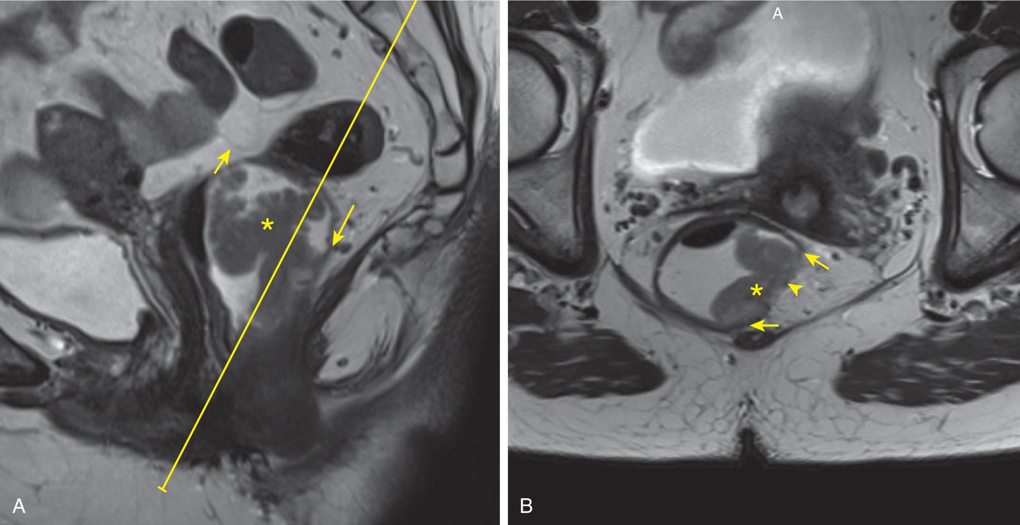 FIGURE 146.1, (A) Sagittal T2 image demonstrating a polypoid low rectal tumor arising from a broad-based in the posterior low rectum (asterisk) . The yellow line present is parallel to the posterior rectal wall at the level of the stalk (large arrow) and proscribes the angle for the axial oblique images to assess the stalk. The tumor base is below the peritoneal reflection (small arrow) indicating that a transanal excision could be considered. (B) Axial oblique T2 image demonstrating the base along the left lateral aspect of the rectal wall (asterisk) , extending the full thickness of the muscularis but not extending deeply into the mesorectal fat (arrowhead) , compatible with a T2/T3a (<1 mm invasion into the mesorectal fat). Observe the replacement of the low signal intensity muscularis propria by intermediate tumor signal compared to the normal muscularis (small arrows) anterior and posterior to the tumor.