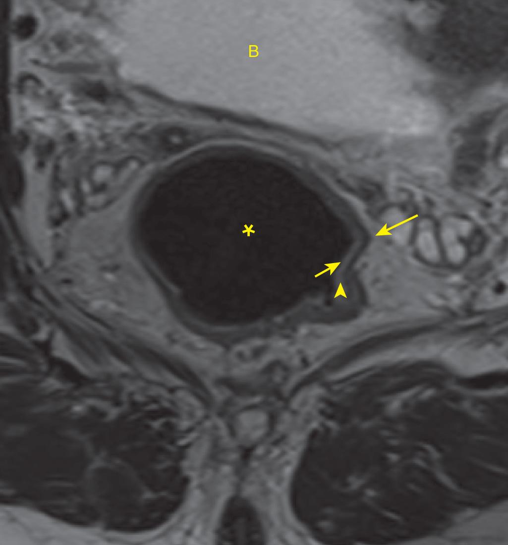 FIGURE 146.5, T2 axial oblique image of a normal rectum. The rectal lumen (asterisk) containing air appears black, and is located posterior to the normal bright urinary bladder (B). The mucosa is visible as a thin, dark band contacting the lumen (small arrow) . The submucosa is the bright layer between the mucosa and submucosa (arrowhead) . The muscularis is the dark ring (large arrow) deep to the submucosa.