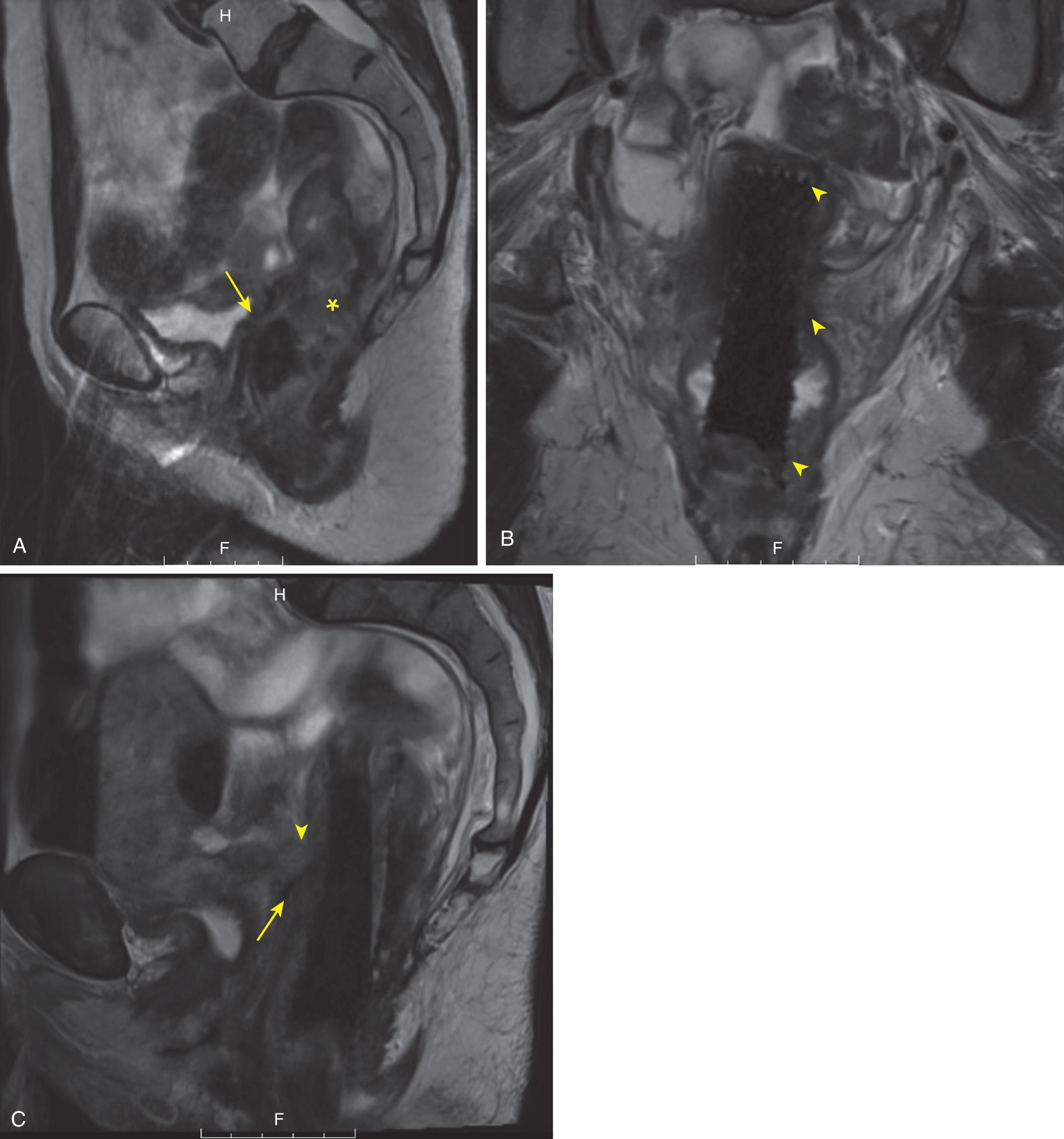 FIGURE 146.3, (A) Long-segment tumor in the mid- to low rectum (asterisk) invading the posterior wall of the vaginal cuff (arrow) . The patient developed obstructive symptoms and a rectal stent was deployed. (B) Coronal image taken from follow-up exam 3 months later demonstrating low signal intensity rectal stent with geometric borders (arrowheads) . The stent results in little artifact. (C) Sagittal image from the repeat exam demonstrating enlargement of the tumor involving the vaginal cuff (arrowhead) with a hypointense gas-filled track between the mass and the rectum (arrow) . A neoplastic rectovaginal fistula was confirmed at pathology.