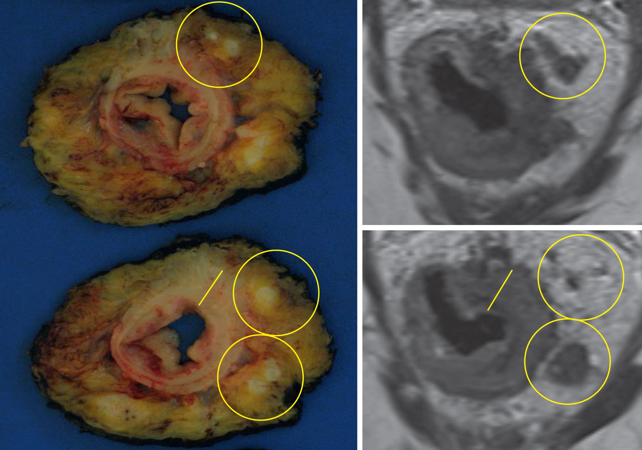 FIGURE 146.4, Axial oblique sections from a mid-rectal tumor specimen with corresponding magnetic resonance imaging slices. The lower panel images demonstrate the tumor arising from the left anterior rectal wall with lines drawn along the most invasive component of the tumor, nicely demonstrating concordance of the depth of invasion in this T3b tumor. Metastatic lymph nodes in the left mesorectum greater than 2 mm from the mesorectum are indicative of a negative circumferential radial margin, which is confirmed on pathology.