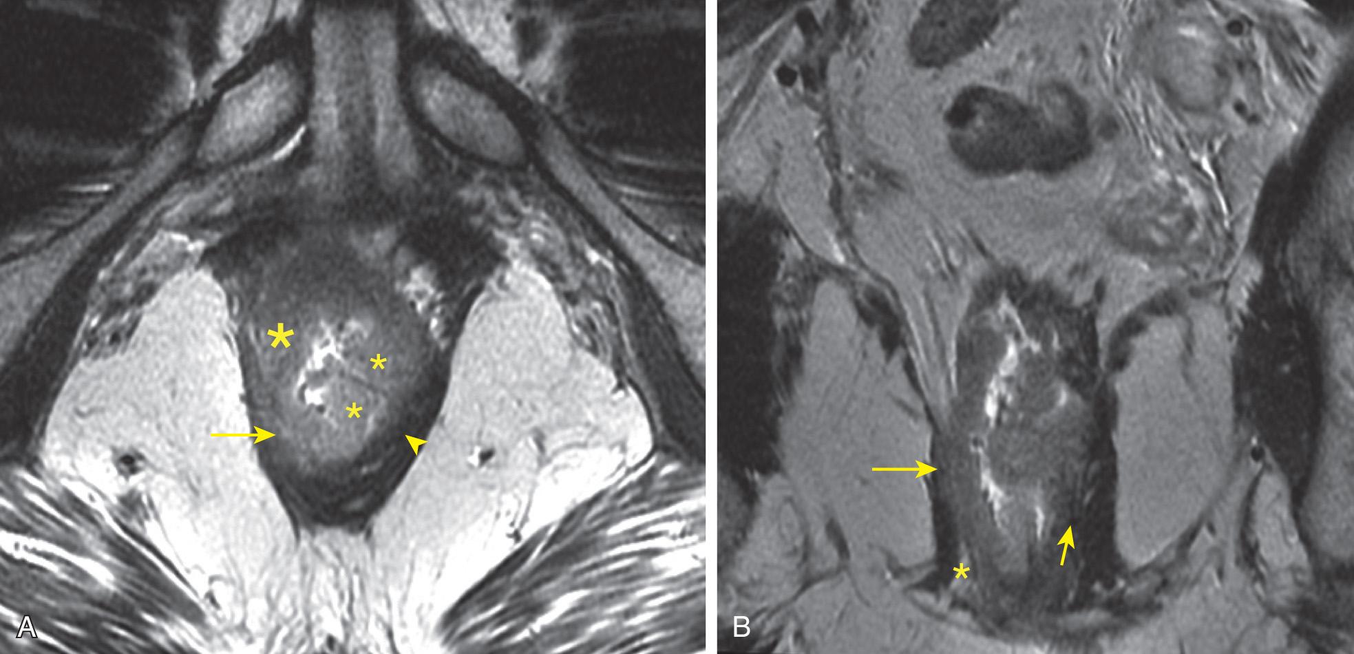 FIGURE 146.6, (A) Axial oblique T2-weighted magnetic resonance image showing a semiannular low rectal tumor arising from the right lateral rectal wall (large asterisk) with large raised rolled edges filling the rectal lumen and converging on the left side of the rectum (small asterisks) . The invasive component on the right invades the internal anal sphincter (arrow) with sparing of the left internal sphincter (arrowhead) . (B) Coronal T2 image showing the intact right intersphincteric plane inferiorly (asterisk) with intermediate signal tumor invading through the right mid- and upper intersphincteric plane into the external anal sphincter (large arrow) . Observe effacement of the normal bright signal of the thin left intersphincteric fat superior to the small arrow . On the basis of intersphincteric plane invasion, this lesion meets criteria for a positive circumferential margin.