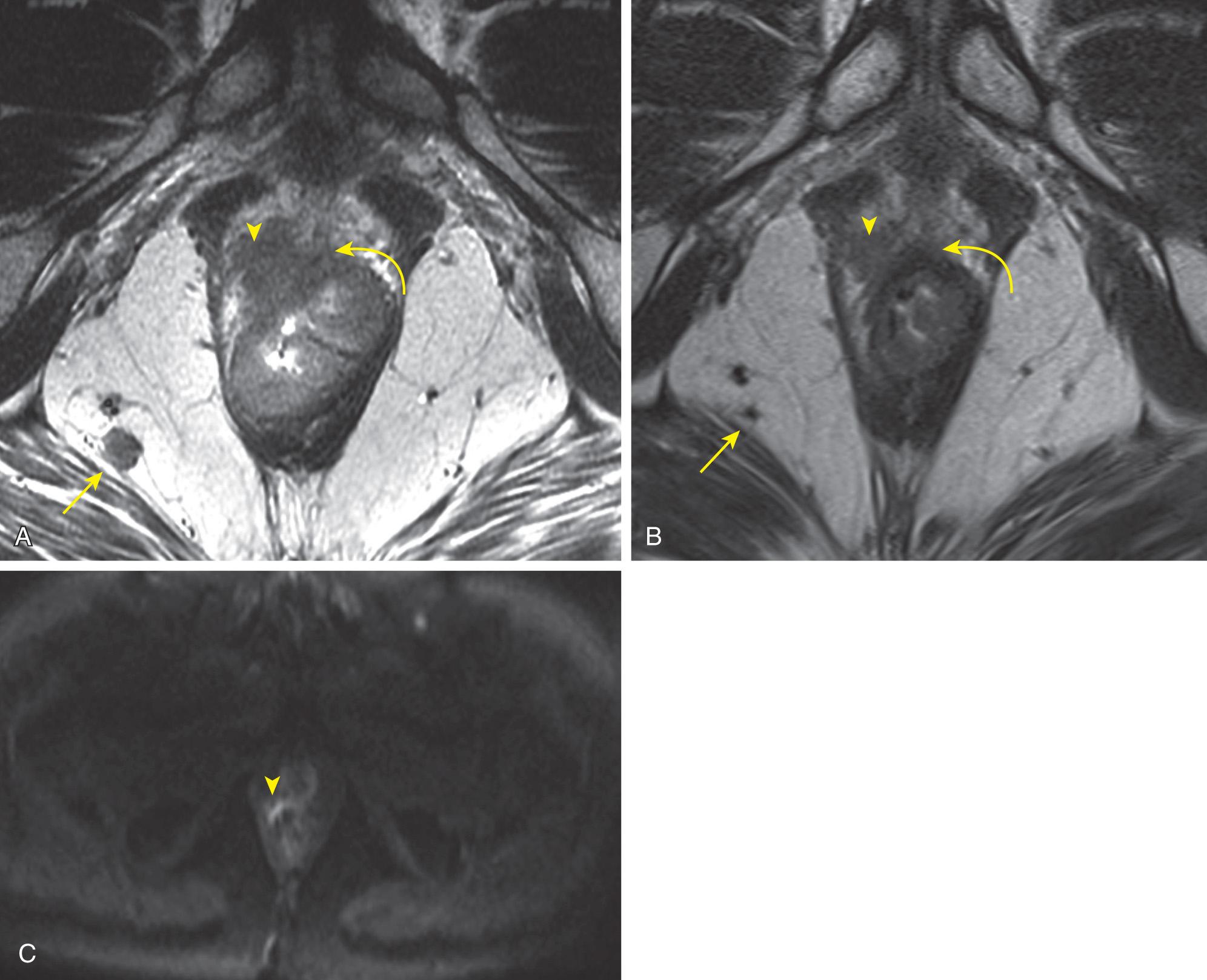 FIGURE 146.7, (A) Baseline axial oblique T2-weighted magnetic resonance (MR) image showing a semiannular low rectal tumor (curved arrow) with intermediate signal in the right anterior rectum with invasion of the prostate apex (arrowhead) . A metastatic lymph node in the right ischiorectal fossa (straight arrow) has a heterogeneous signal and irregular borders. (B) Axial oblique T2-weighted MR image showing the same tumor postneoadjuvant chemoradiation therapy. Observe the predominantly dark fibrosis in the mural component of the tumor with little intermediate signal (curved arrow) , suggesting tumor regression grade 2, but a residual intermediate-signal viable tumor invades the prostate apex (arrowhead) indicating tumor regression grade 4. The treated metastatic lymph node is now less than 5 mm, and has a dark signal typical of fibrosis without evidence of residual tumor (straight arrow) . (C) Axial large field-of-view diffusion-weighted magnetic resonance image showing residual viable tumor at the site of prostate invasion with persistent diffusion abnormality (arrowhead) . Final pathology confirmed a T4b lesion invading the right prostate apex.