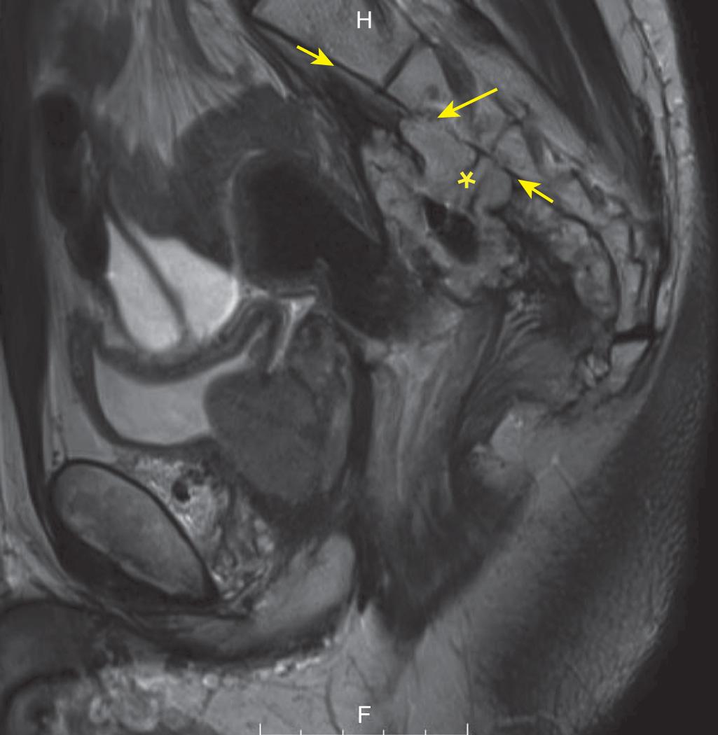 FIGURE 146.8, Large recurrent rectal tumor (asterisk) arising from a colorectal anastomosis invading the sacrum. Observe the destruction of the anterior sacral cortex in the mid-S2 segment that is normally a thin dark line cranial and caudal to the tumor (short arrows) , which has been replaced with intermediate tumor signal (long arrow) .