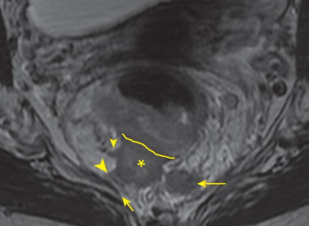 FIGURE 146.9, Axial oblique T2-weighted image showing a T3 semiannular low rectal tumor with invasive edge along the right posterior wall (asterisk) with greater than 15-mm extramural spread beyond the expected location of the outer border of the muscularis propria (curved line) indicating T3d disease. Extramural vascular invasion (large arrowhead) expands a vein along the posterior right aspect of the tumor coming within 1 mm of the thin, linear, dark band of mesorectal fascia (small arrow) , indicating a positive circumferential radial margin. An additional expansile tumor is in a vein along the right lateral wall (small arrowhead) . A heterogeneous signal metastatic node with irregular borders in the left posterior mesorectum (long arrow) is 2 mm from the mesorectal fascia, resulting in a threatened radial margin.