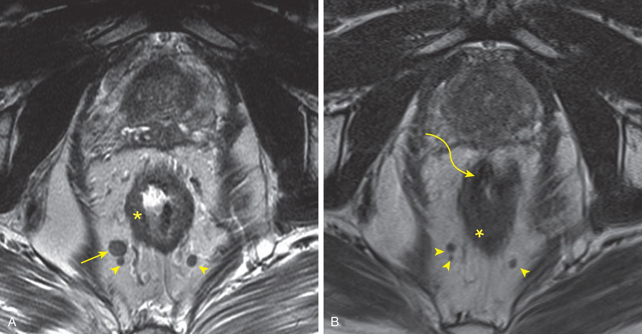 FIGURE 146.11, (A) An axial oblique T2-weighted magnetic resonance image showing a near circumferential T3 annular low rectal tumor (asterisk) with a metastatic heterogeneous signal perirectal lymph nodes (arrow) with two additional smaller suspicious nodes (arrowheads) . (B) An axial oblique T2-weighted magnetic resonance image showing the primary tumor persists, with equal amounts of gray intermediate signal tumor (asterisk) and dark hypointense fibrosis (curved arrow) compatible with tumor regression grade 3. The same nodes postneoadjuvant therapy (arrowheads) have decreased in size, but have a persistent intermediate signal supporting viable tumor, which was confirmed at pathology.