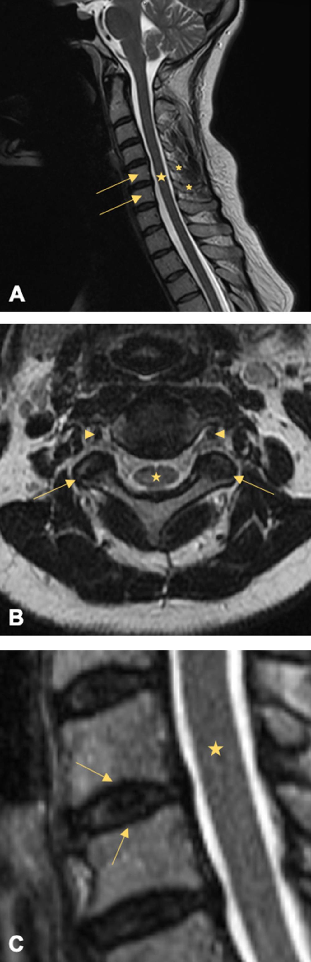 Fig. 1, T2-weighted MRI of the human cervical spine. The C1-C7 vertebral bodies (arrows) , spinous processes (asterisks) , and spinal cord (star) within the spinal canal is best appreciated in the midsagittal perspective (A). Axial view shows the facet joints (arrows) , transverse processes and foramina (arrowheads) , and a cross-section of the spinal cord ( star ; B). Higher magnification in the midsagittal frame allows enhanced visualization of the intervertebral discs (star) and vertebral endplates ( arrows ; C).