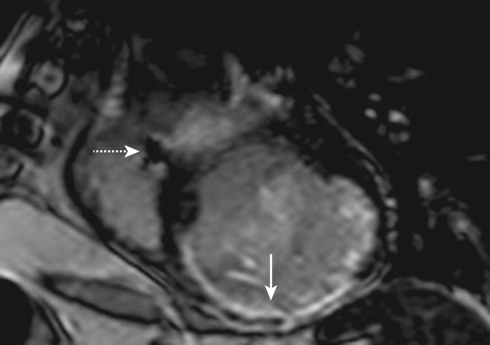 Fig. 65.1, Short-axis magnetic resonance image demonstrating right and left ventricles with an inferior transmural infarction in the left ventricle ( solid arrow ). An implantable cardioverter defibrillator lead artifact is visualized in the right ventricle ( dashed arrow ).