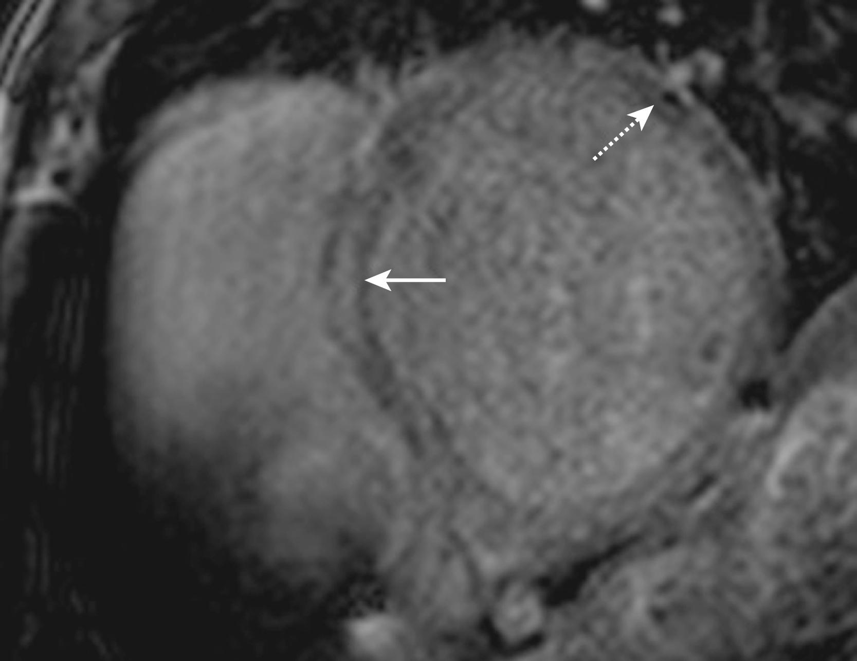 Fig. 65.2, Short-axis image focusing on the right and left ventricles demonstrating atypical and diffuse pattern of scar in nonischemic cardiomyopathy. In this three-dimensional navigator-gated image, the contrast-to-noise ratio is sacrificed to provide greater spatial resolution. Striae of midwall late gadolinium enhancement are readily visualized in the septum ( solid arrow ) and lateral wall ( dashed arrow ).
