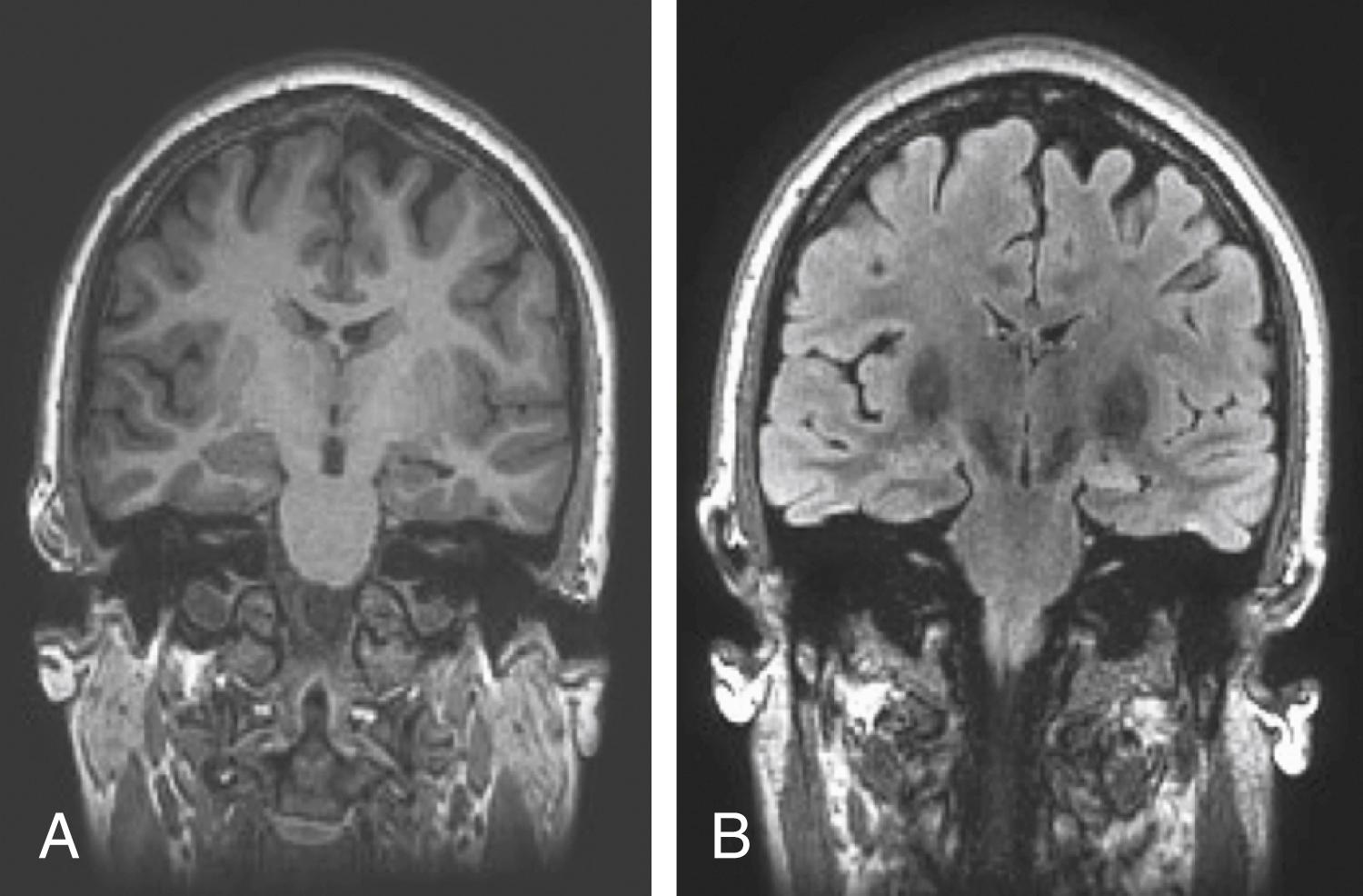 Figure 84.1, Hippocampal sclerosis.