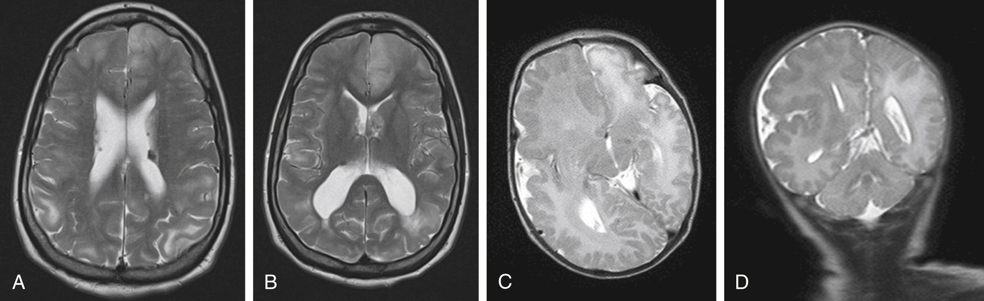 Figure 84.2, Malformations of cortical development, group I.