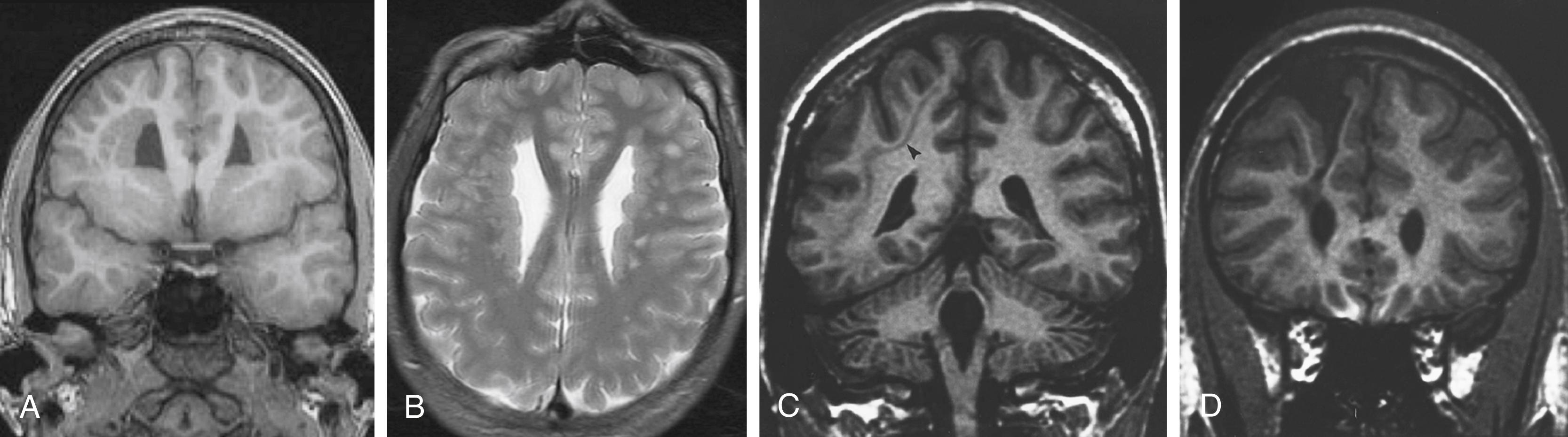 Figure 84.3, Malformations of cortical development, group II.