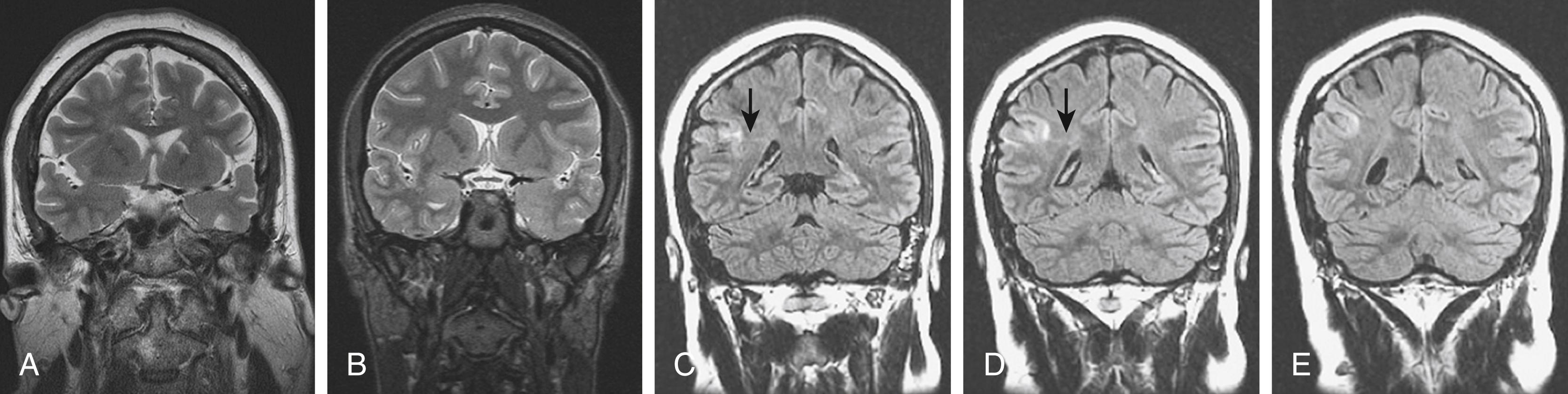 Figure 84.4, Focal cortical dysplasia (FCD).