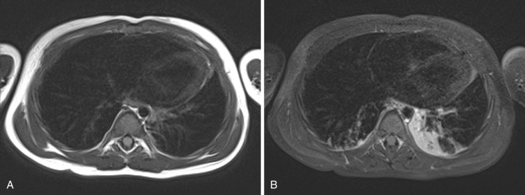 FIG 6-1, Atelectasis and sedation. Chest MRI in a sedated 2-year-old girl with neuroblastoma. A, Precontrast axial T1 BLADE image at the beginning of the scan showing no atelectasis. B, Postcontrast axial T1 BLADE FS image acquired 20 minutes later showing significant atelectasis in the left lung.