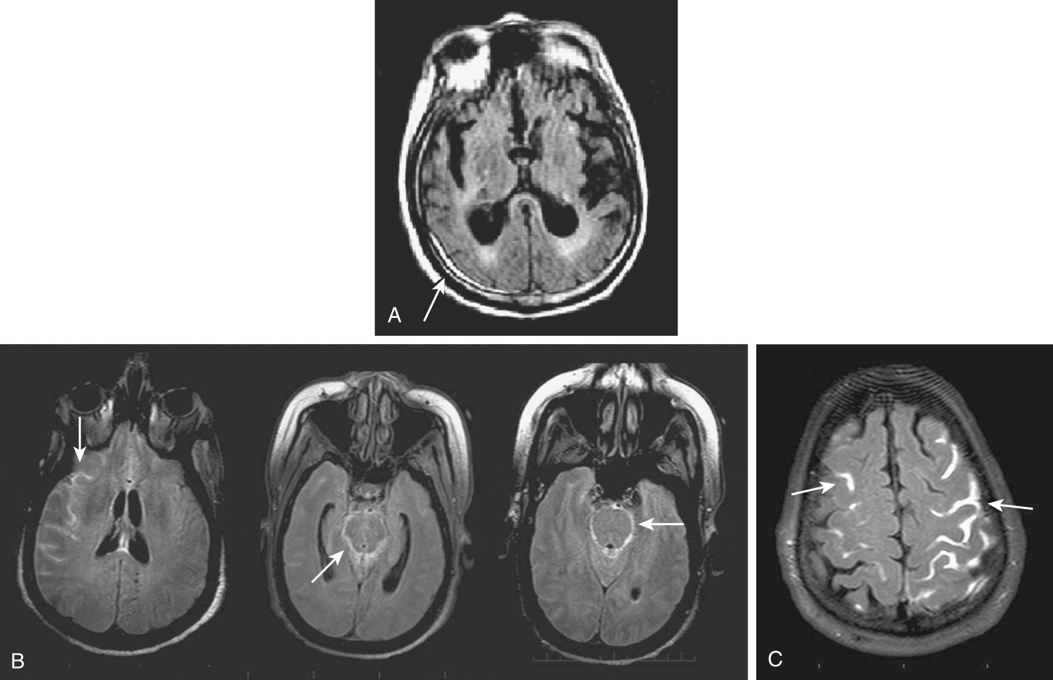 Fig. 48.2, Extra-axial hyperintensity on fluid-attenuated inversion recovery (FLAIR). (A) An example of a subdural hematoma seen on FLAIR (arrow) , with clear contrast between the hyperintensity of the blood and the background tissue. This small subdural hematoma was not seen on computed tomography (CT). (B) FLAIR images from a 47-year-old man with a subarachnoid hemorrhage. Blood appears hyperintense in the subarachnoid space at multiple levels. (C) FLAIR images showing gadolinium enhancement of cerebrospinal fluid in hemispheric sulci (arrows) after intravenous tissue-type plasminogen activator treatment. This is the hyperintense acute reperfusion marker (HARM) sign, which indicates early blood-brain barrier disruption in stroke and is associated with reperfusion and increased risk of hemorrhagic transformation. The HARM sign is more likely to be seen following thrombolytic therapy. The main imaging differential is blood, which can be ruled out by gradient recalled echo MRI or CT.