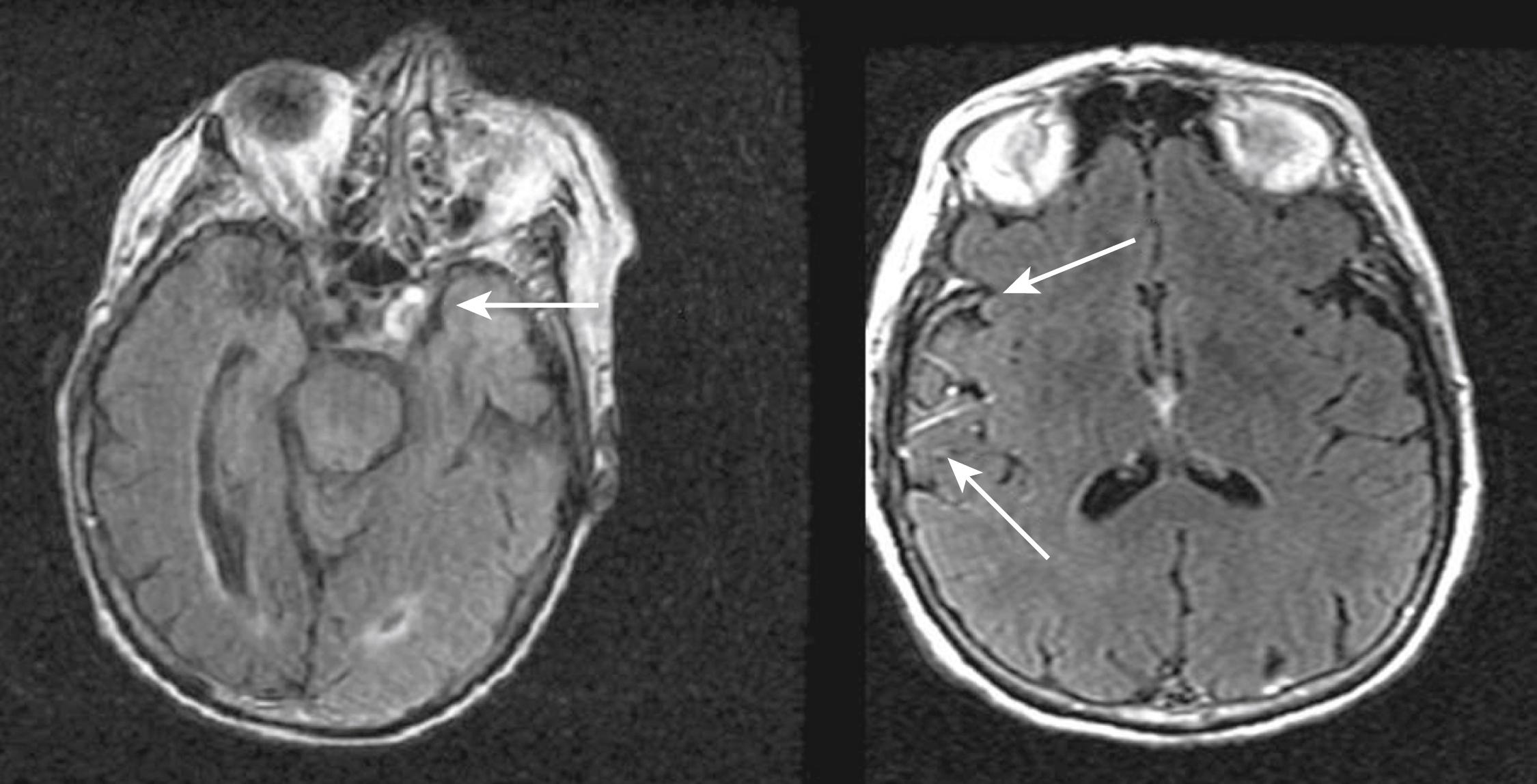 Fig. 48.3, Fluid-attenuated inversion recovery (FLAIR) hyperintense vessel sign. Left, Hyperintense vessel sign on FLAIR imaging in a patient with a 2-hour-old occlusion of the left internal carotid artery (arrow) . Note the normal flow void (hypointensity) of the contralateral carotid artery. Right, Hyperintense vessel (arrows) sign in branches of the right middle cerebral artery territory distal to an occlusion, indicating slow flow in a patient with penumbral flow in that territory.