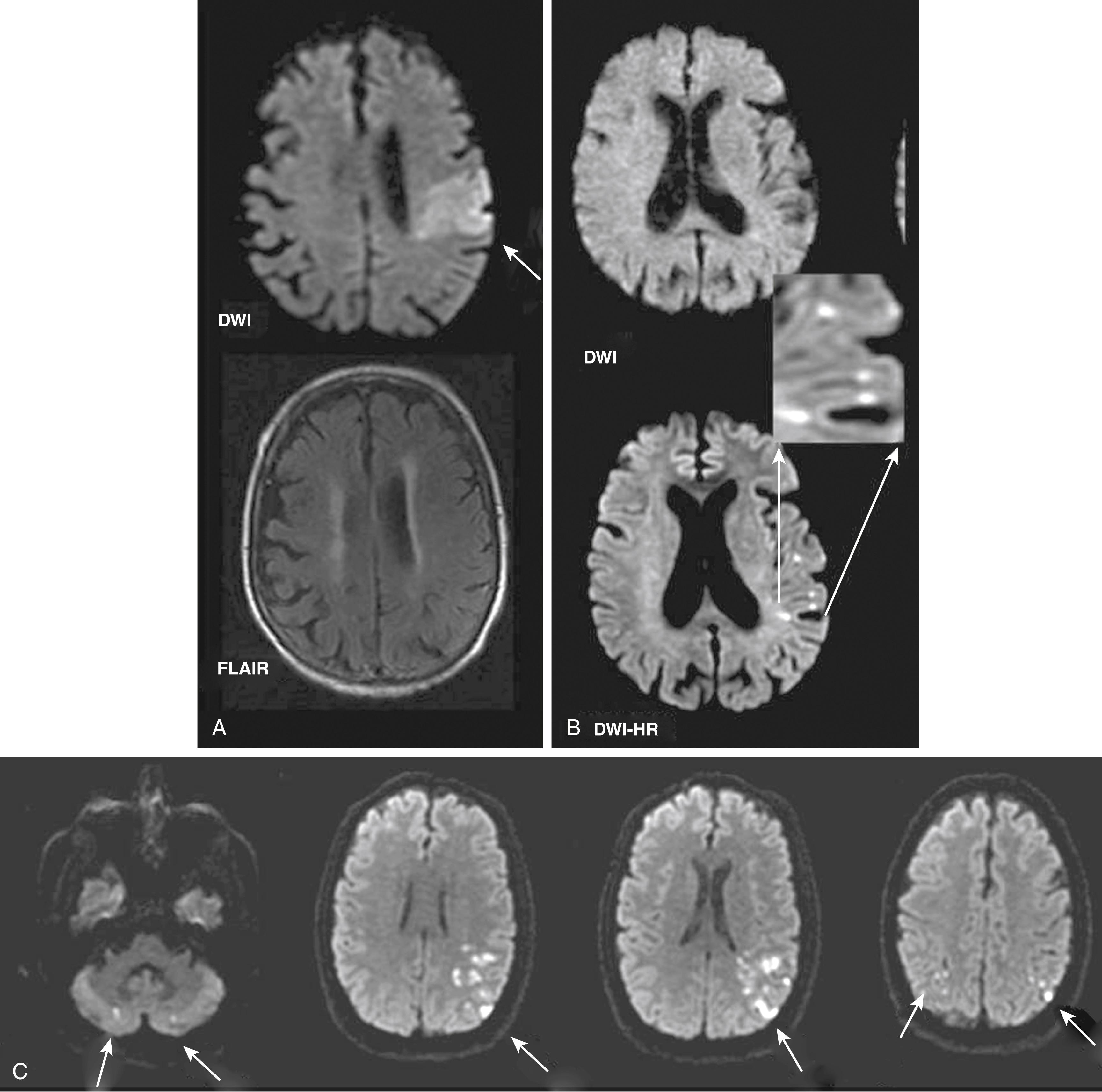Fig. 48.4, Detection of hyperacute ischemic stroke with diffusion-weighted imaging (DWI) . (A) The characteristic MRI pattern of hyperacute ischemic stroke, which is DWI-positive (arrow) and fluid-attenuated inversion recovery (FLAIR) -negative. (B) High-resolution DWI (DWI-HR) may reveal punctate acute ischemic lesions not seen on the more typical lower-resolution DWI. The use of DWI-HR may further reduce the probability of false-negative DWI in stroke. (C) Acute ischemic lesions (arrows) in multiple arterial territories suggestive of cardioembolic mechanism.