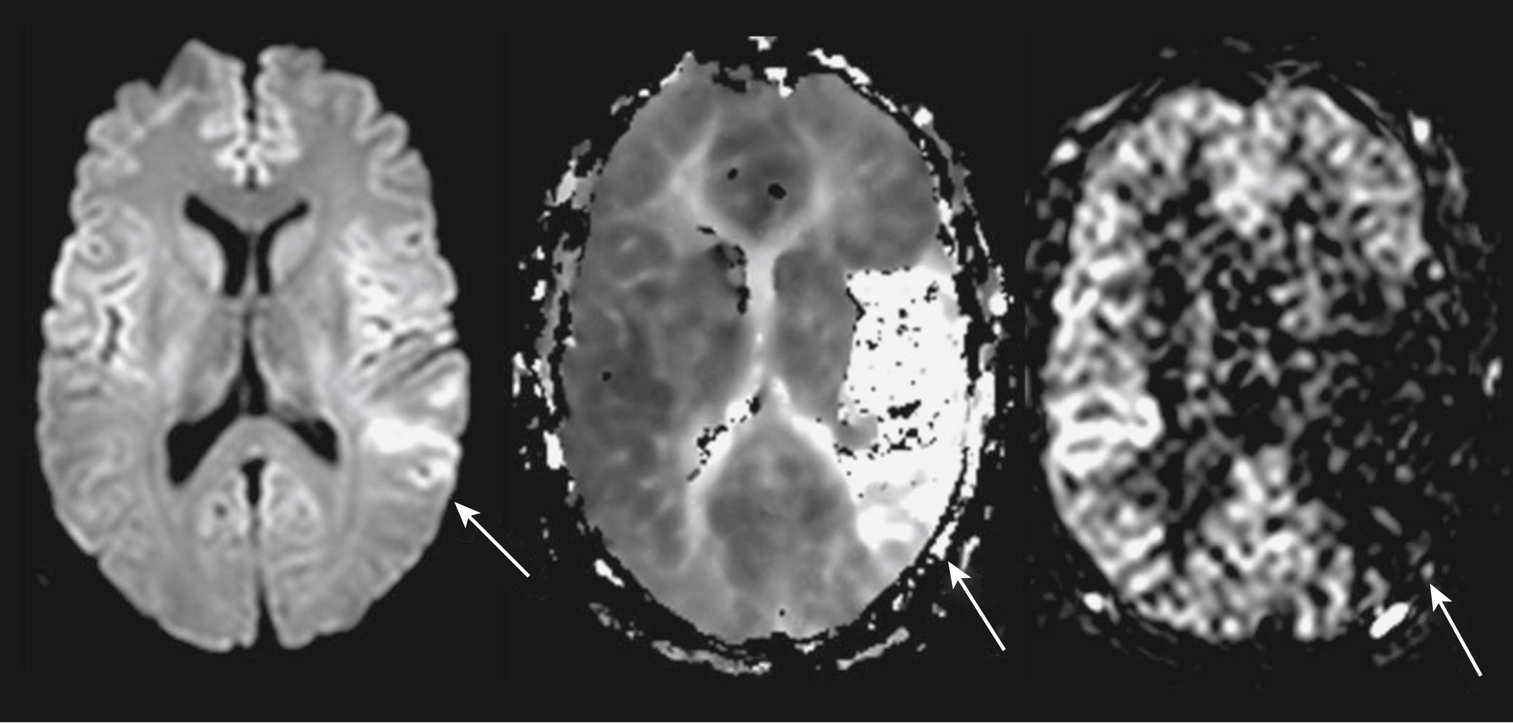 Fig. 48.5, MR perfusion imaging. (A) Acute ischemic changes in left middle cerebral artery territory on diffusion-weighted imaging (DWI). (B) Larger region of ischemia on perfusion mean transit time (MTT) map using the standard dynamic susceptibility contrast (DSC) method. (C) MR perfusion without gadolinium is acquired using arterial spin labeling (ASL), showing a comparable perfusion defect on this relative cerebral blood flow map obtained 1 hour 40 minutes after stroke onset. Arrows point to regions of abnormality.