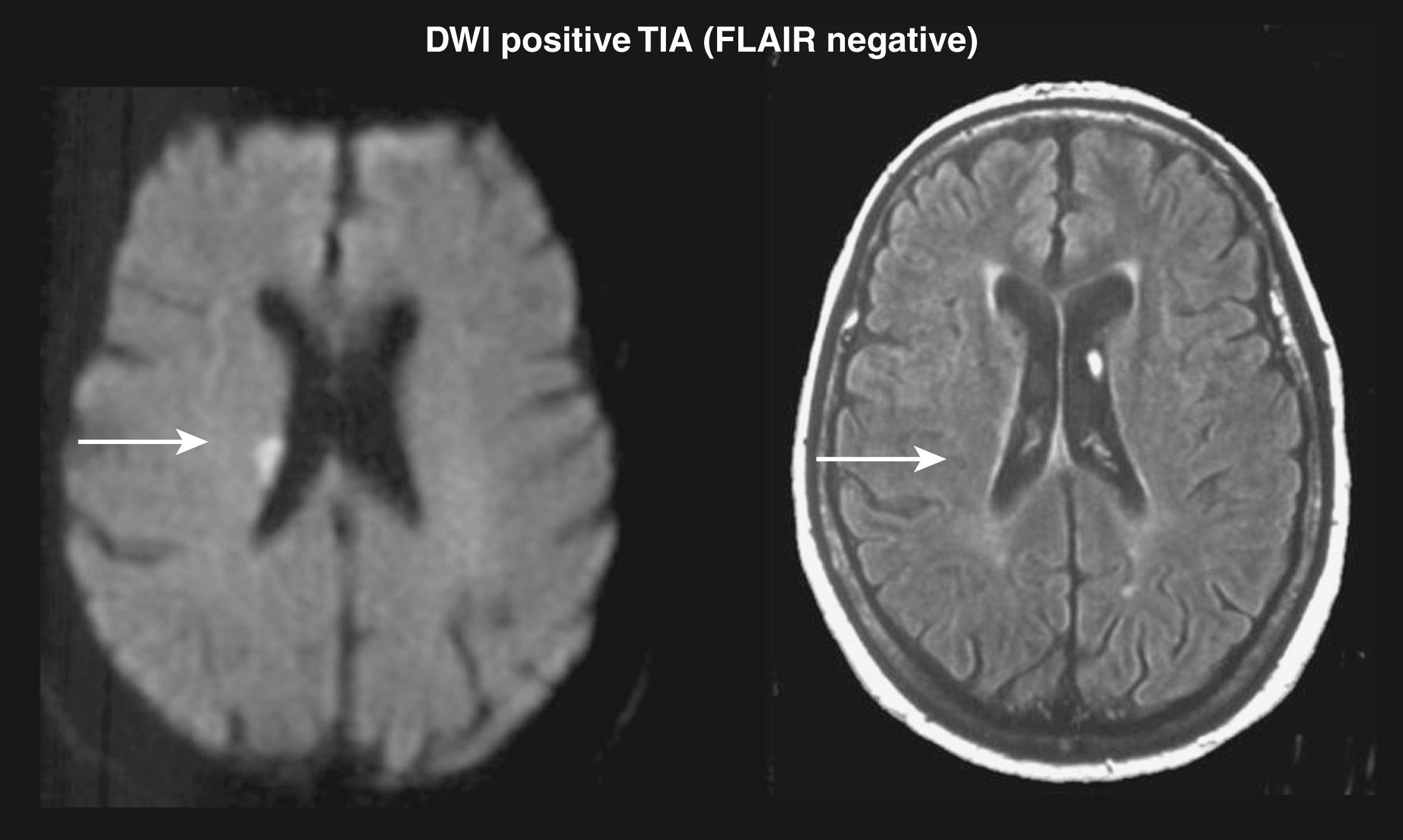 Fig. 48.6, Diffusion-weighted imaging (DWI) of a patient with a transient ischemic attack (TIA) . MRI findings in a 63-year-old man with a 30-minute episode of left arm weakness, imaged 4 hours after resolution. Left, DWI sequence shows right periventricular white matter lesion ( arrow ) not apparent on the fluid-attenuated inversion recovery (FLAIR) sequence (right, arrow) .